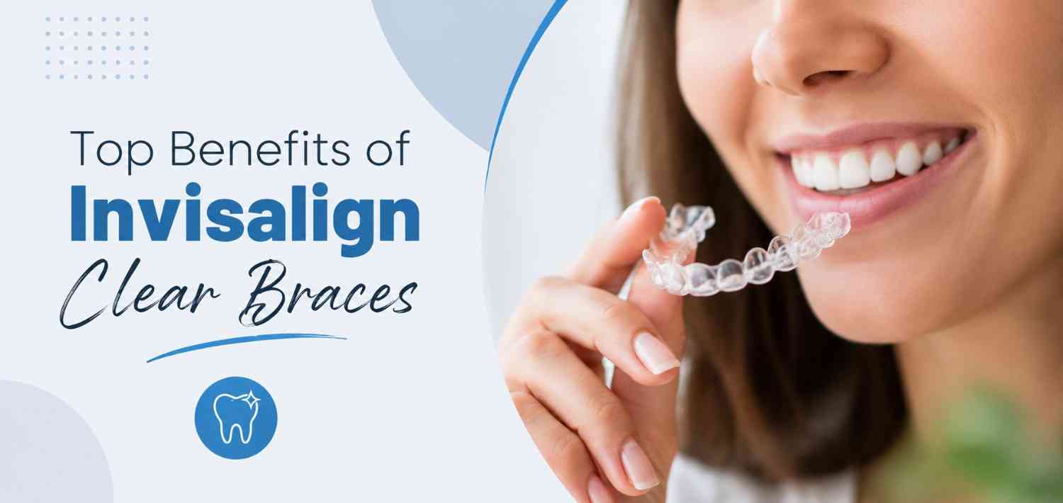 Top Benefits of Invisalign Clear Braces